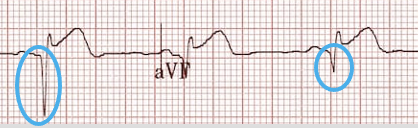 <p>pathological Q waves</p>