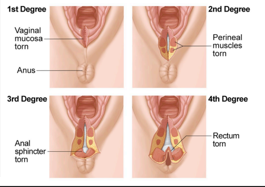 <p><strong>Perineal Lacerations</strong></p><p>-Lacerations are repaired after _________ delivery&nbsp;</p><p>-Most common site is the perineal ____</p><p>-Classification System</p><ul><li><p>1st degree = injury to perineal _____ only&nbsp;</p></li><li><p>2nd degree = injury to perineum involving perineal ________</p></li><li><p>3rd degree = injury to perineum involving anal _________ complex&nbsp;</p></li><li><p>4th degree = injury to perineum involving anal sphincter complex and anal ___________</p></li></ul><p></p>