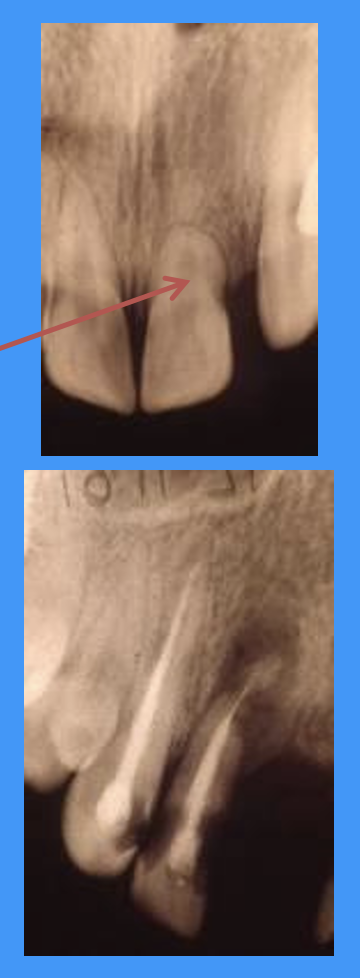 <p>what does the red arrow and bottom radiograph show</p>