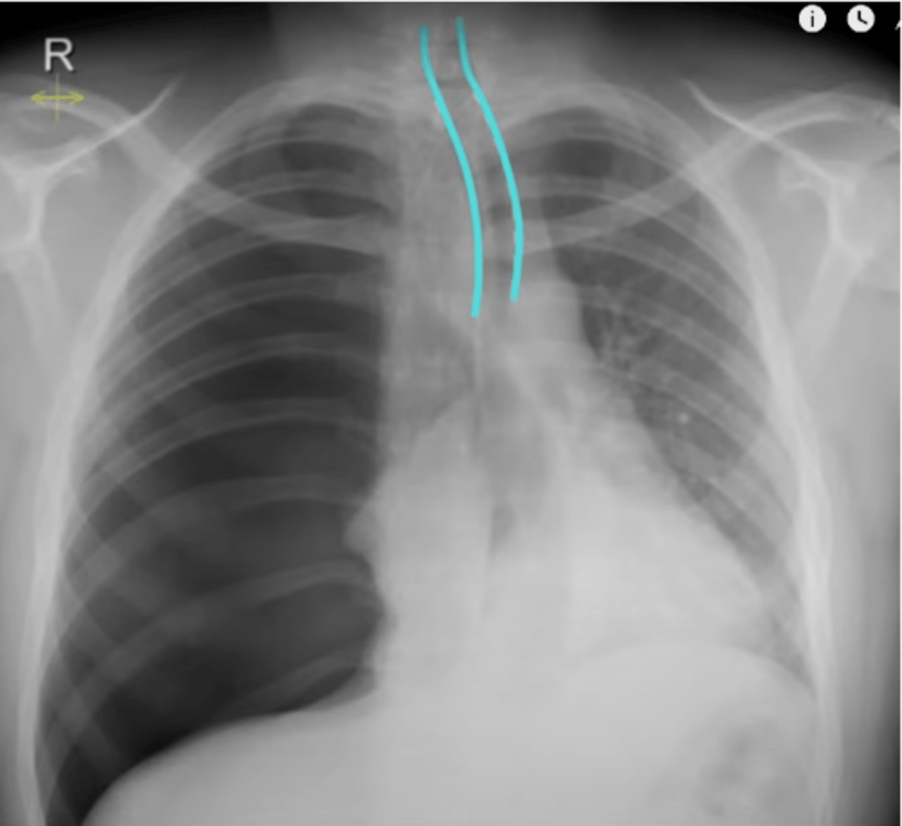 <p>-away from one side</p><p>-large pleural effusion</p><p>-tension pneumothorax</p><p>-mass/adenopathy</p>