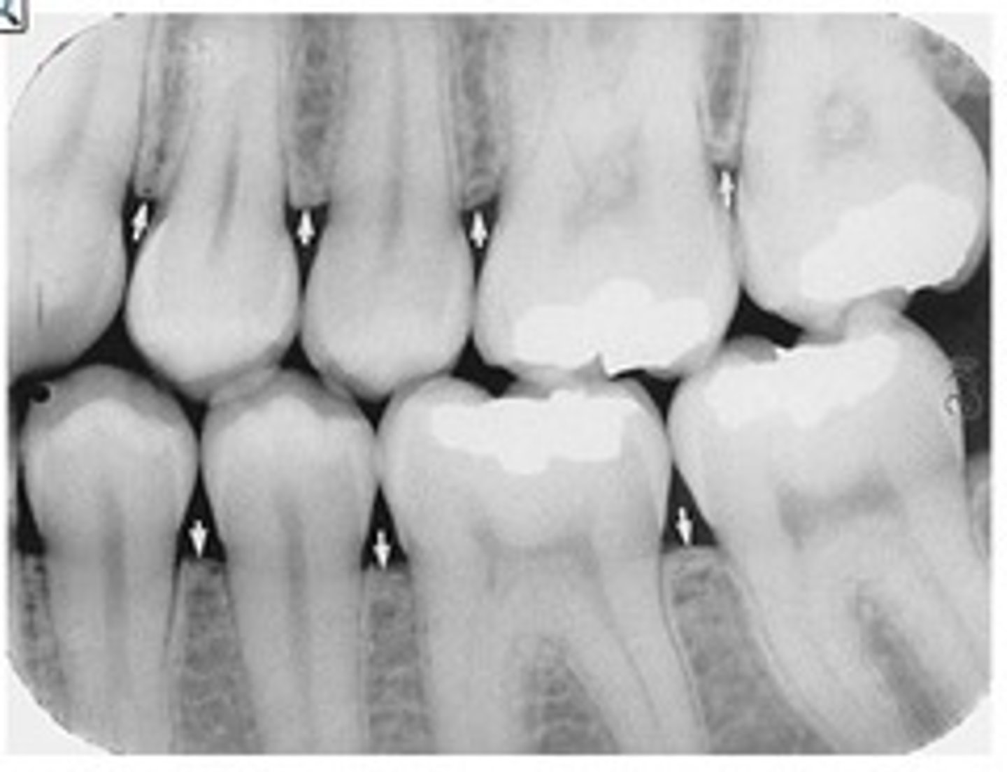<p>Radiopaque; composed of cortical and cancellanious bone; part of bone where tooth eruption occurs</p>