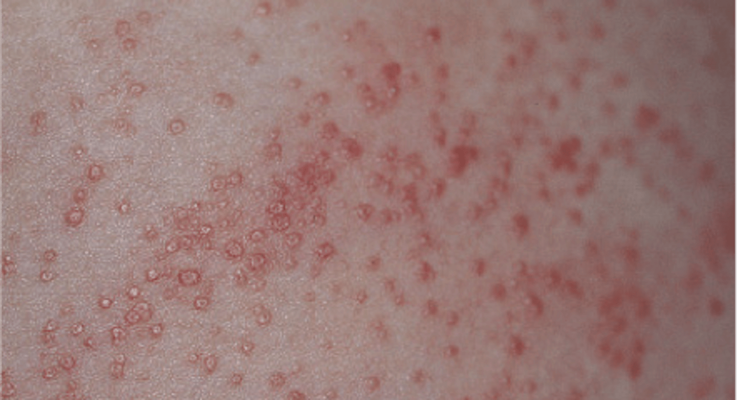 <p>Prickly heat; acute inflammatory disorder of the sweat glands</p>