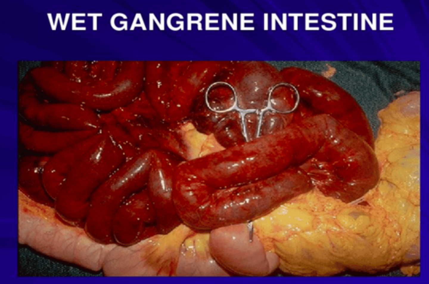 <p>Area of gangrene with secondary bacterial infection and pus</p>