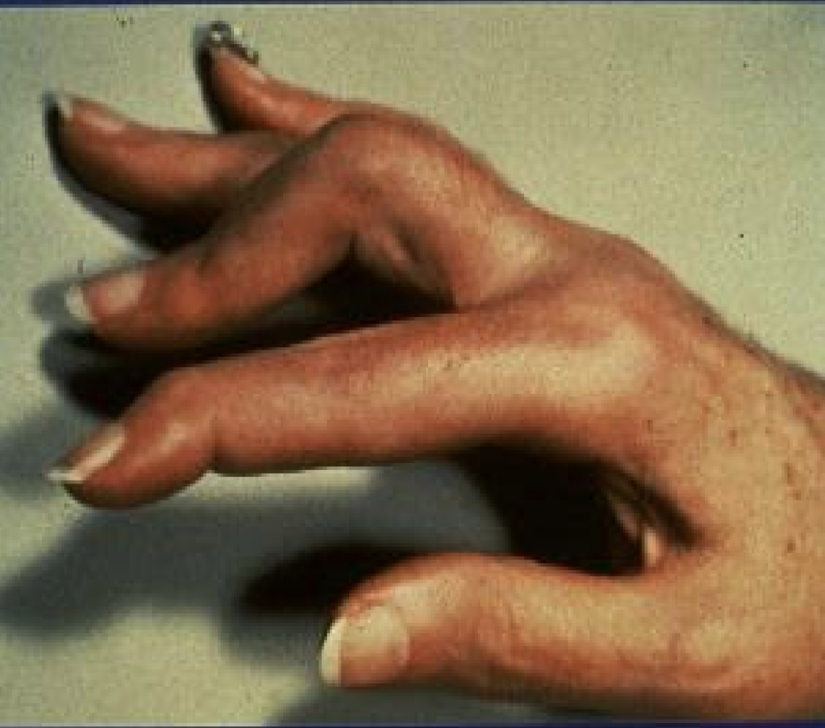 <p>Which RA deformity?</p>