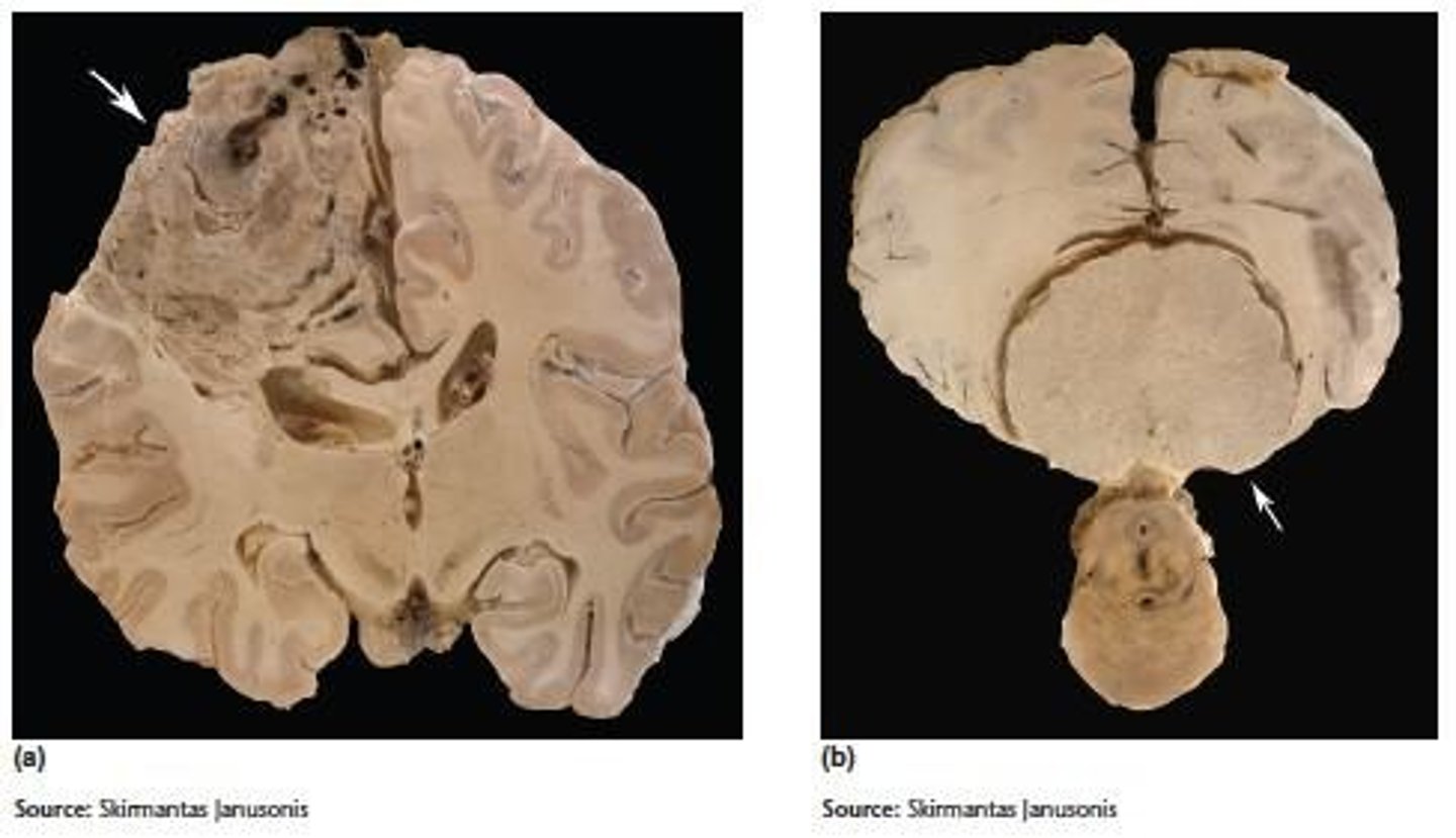 <p>A rare prion disease that can be genetic or caused by infection from unclean surgical equipment.</p>