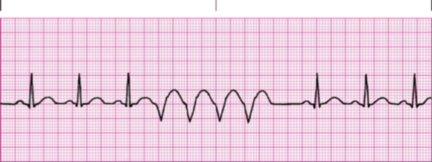 <p>three or more successive PVCs (Vtach)</p>