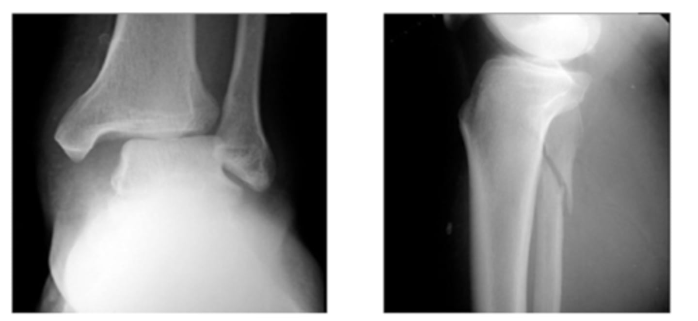 <p>Tear of the tibiofibular ligament</p><p>Widening of the ankle mortise medially</p>