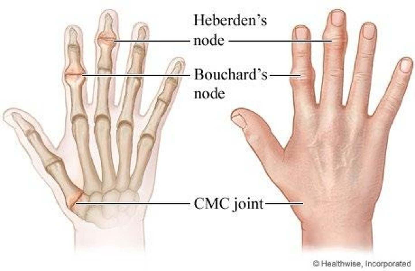 <p>They are bony swellings in the hands indicative of osteoarthritis.</p>