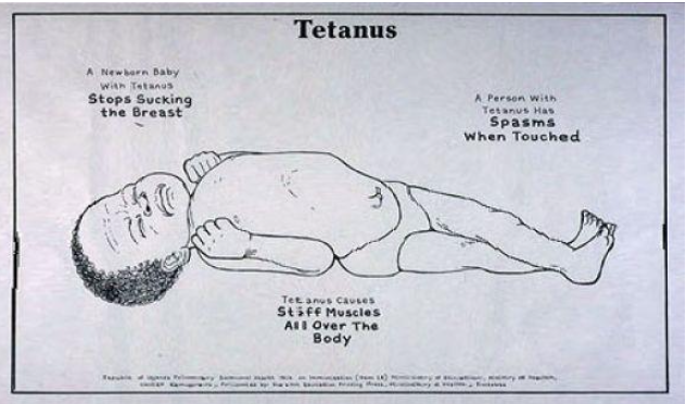 <p>From infected umbilical cord</p>