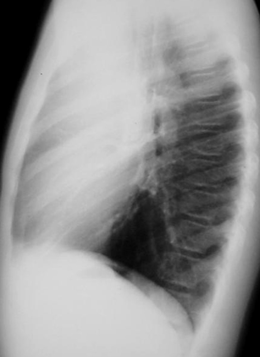 <p>What is the most common anterior mediastinal mass?</p>