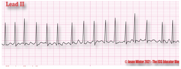 <ul><li><p class=""><strong>Rate</strong>: <em>Atrial</em> — <mark data-color="yellow" style="background-color: yellow; color: inherit">300 to 600 bpm</mark>; <em>Ventricular</em> — Variable, between <em><u>100 to 200 bpm</u></em></p></li><li><p class=""><strong>Rhythm</strong>: Highly irregular</p></li><li><p class=""><strong>P Waves</strong>: No discernible P waves; irregular, undulating waves (fibrillatory or <em>f</em> waves)</p></li><li><p class=""><strong>P to QRS Ratio</strong>: Many:1</p></li><li><p class=""><strong>PR Interval</strong>: Absent; unmeasurable due to lack of P waves</p></li><li><p class=""><strong>QRS Complex</strong>: Usually normal</p></li></ul><p></p>