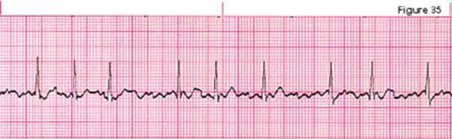 <p>What is this rhythm? and how is it treated?</p>