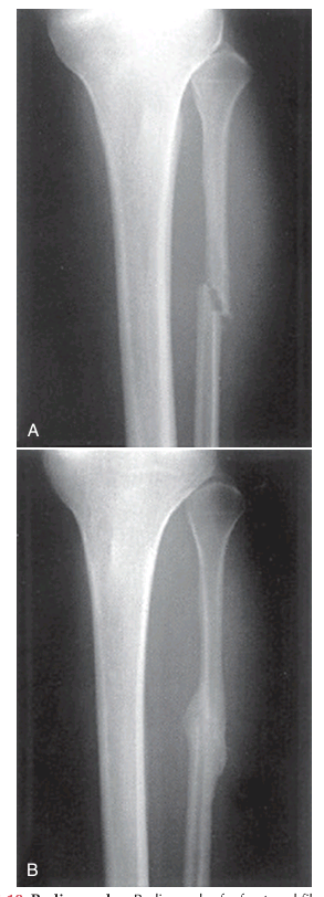 <p> images are produced on photographic plates by passing x-rays (roentgen rays) through the body. Difficult to interpret because the three dimensionality is lost on the planar images.</p>