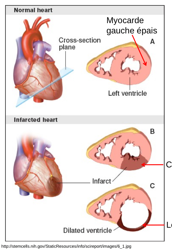 <ul><li><p>myocarde meurt pcque vaisseaux coronaire (blockage)</p></li><li><p>myocarde myocarde ne peut plus pomper sang efficacement → sang reste dans ventricule → pression augm. → dilatation ventricule → épicarde touche feuillet pariétal (BAD!!) → myocarde mince</p></li></ul><p></p>