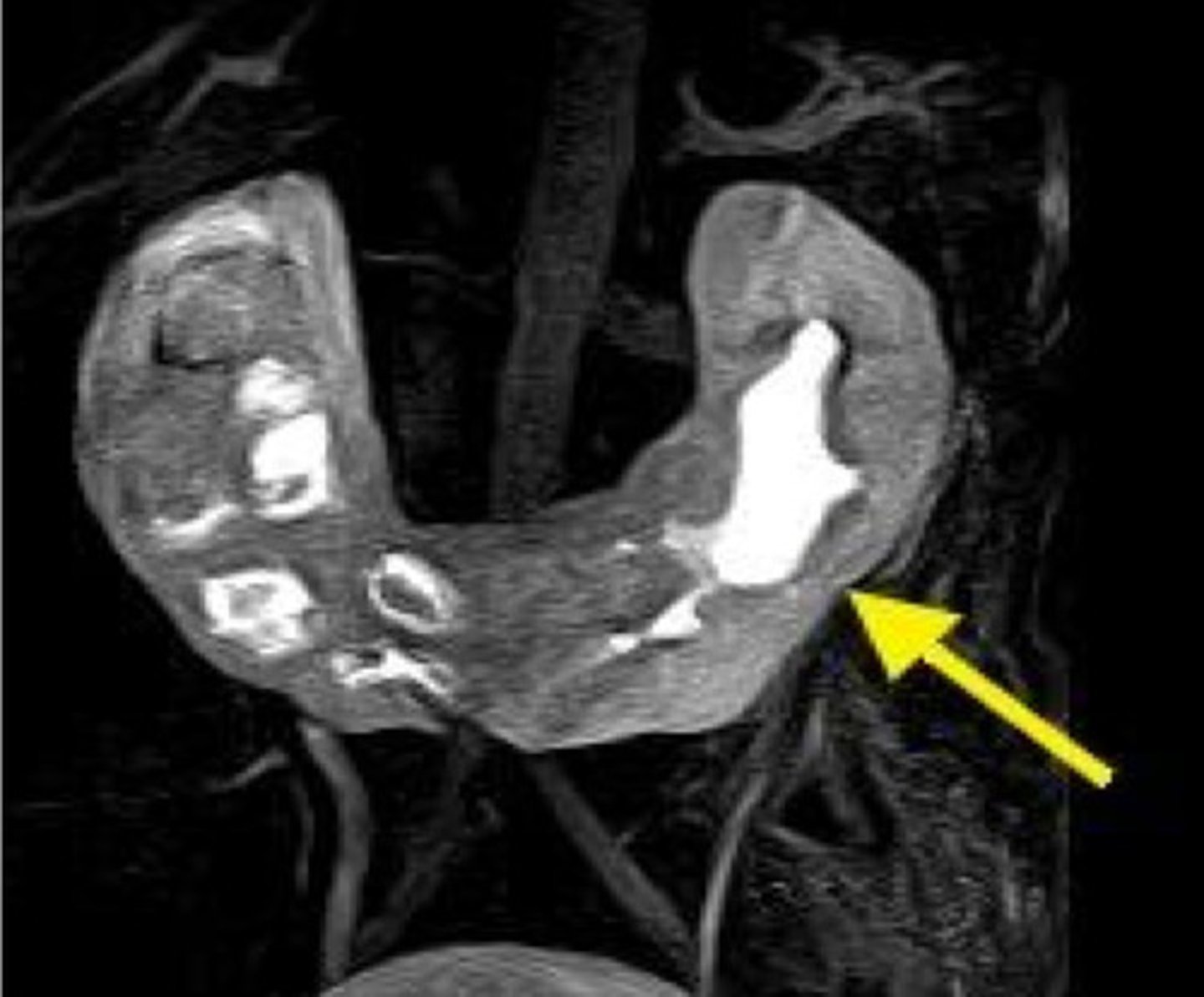 <p>Baby has horseshoe shaped kidneys</p>