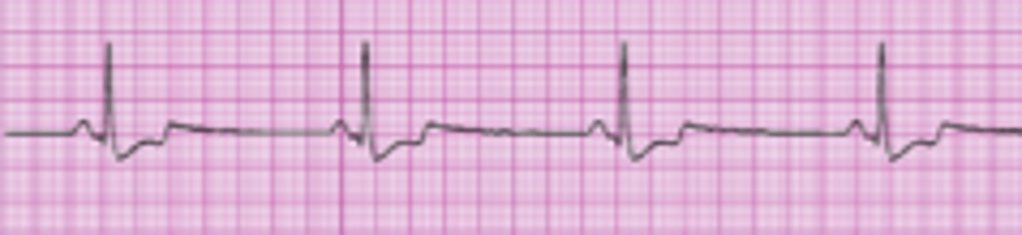 <p>- &lt;60 bpm</p><p>- Common causes: weakened or damaged SA node, hypoxemia, increased ICPs, OSA.</p><p>- Severe cases: decreased CO, BP, and tissue hypoxia.</p><p>- poor capillary refill, cold, clammy and depressed sensorium. </p><p>- Treatment: Atropine and oxygen</p>