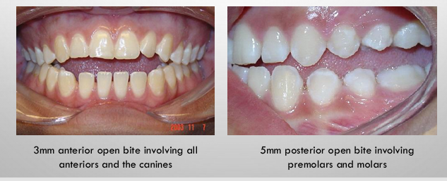 <p>-present when there is no vertical overlap of the maxillary and mandibular anterior teeth or no contact between the maxillary and mandibular posterior teeth</p><p>-recorded as mm between incisal edges of maxillary and mandibular teeth</p><p>-can also record as negative overbite (i.e. -5mm overbite)</p>