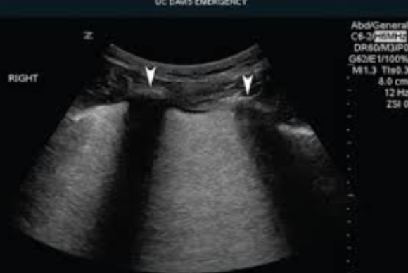 <ul><li><p><span style="background-color: transparent;">Caused by a highly attenuating structure</span></p><ul><li><p><span style="background-color: transparent;">Reflection</span></p></li><li><p><span style="background-color: transparent;">Scattering</span></p></li><li><p><span style="background-color: transparent;">Absorption</span></p></li><li><p><span style="background-color: transparent;">Refraction</span></p></li><li><p><span style="background-color: transparent;">Combination of any of these</span></p></li></ul></li><li><p><span style="background-color: transparent;">Complete absence of echo information behind attenuating structure</span></p></li><li><p><span style="background-color: transparent;">Can be reduced by spatial compounding</span></p><ul><li><p><span style="background-color: transparent;">Different angles can angle behind these attenuating structures</span></p></li></ul></li></ul><p></p>