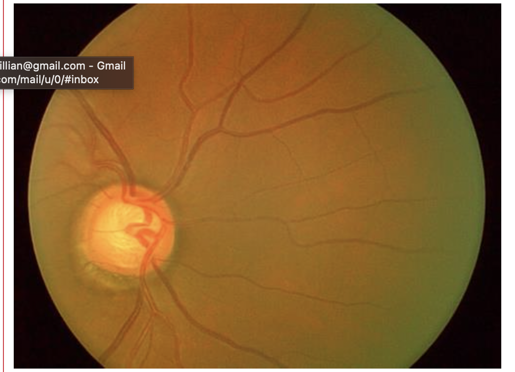 <p>cupping of optic disc seen in ? </p>