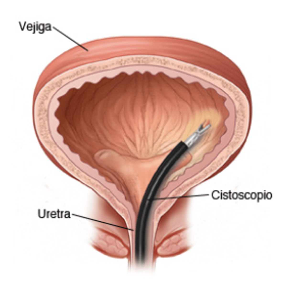 <p>Diagnostica la lesión en tiempo real.</p><p>Permite extraer el tumor en el mismo procedimiento.</p>