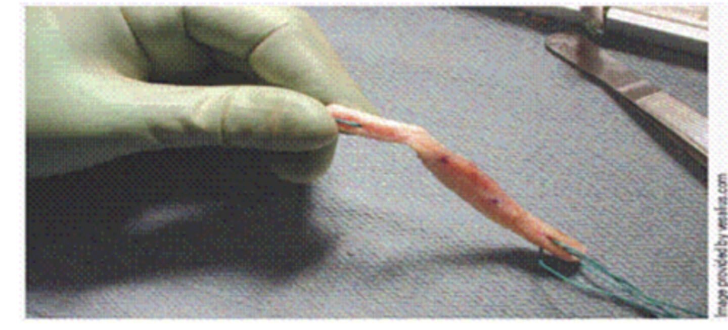 <p>This picture shows prepared ACL graft.</p><p>(T/F)</p>