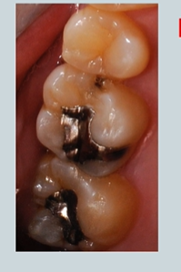 <p>we have found caries - but what’s it’s activity?</p>