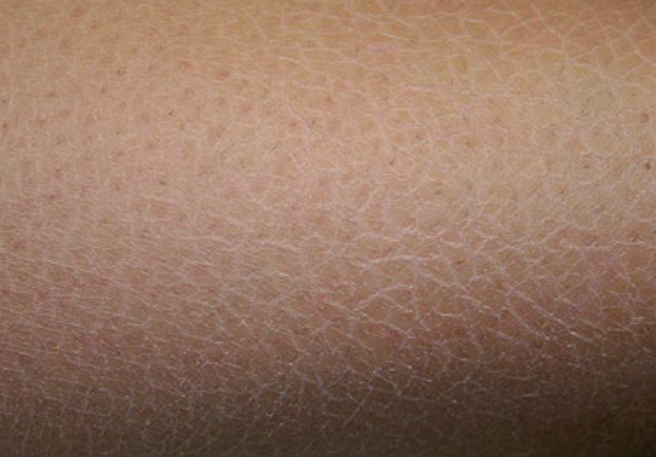 <p>what type of lesion and what condition is depicted</p>