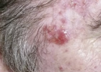 <p>What is cutaneous squamous cell carcinoma caused by?</p>