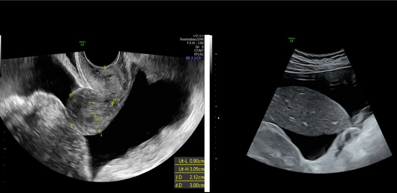 <p>which ovarian tumor is commonly a part of Meigs syndrome </p><p>a) fibroma</p><p>b) cystadenoma</p><p>c) teratoma</p><p>d) androblastoma</p>