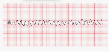 <p>What ECG rhythm is this? Is it shockable?</p>
