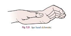 <p>Ape Hand deformity</p>