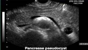 <p>Pseudocyst</p>