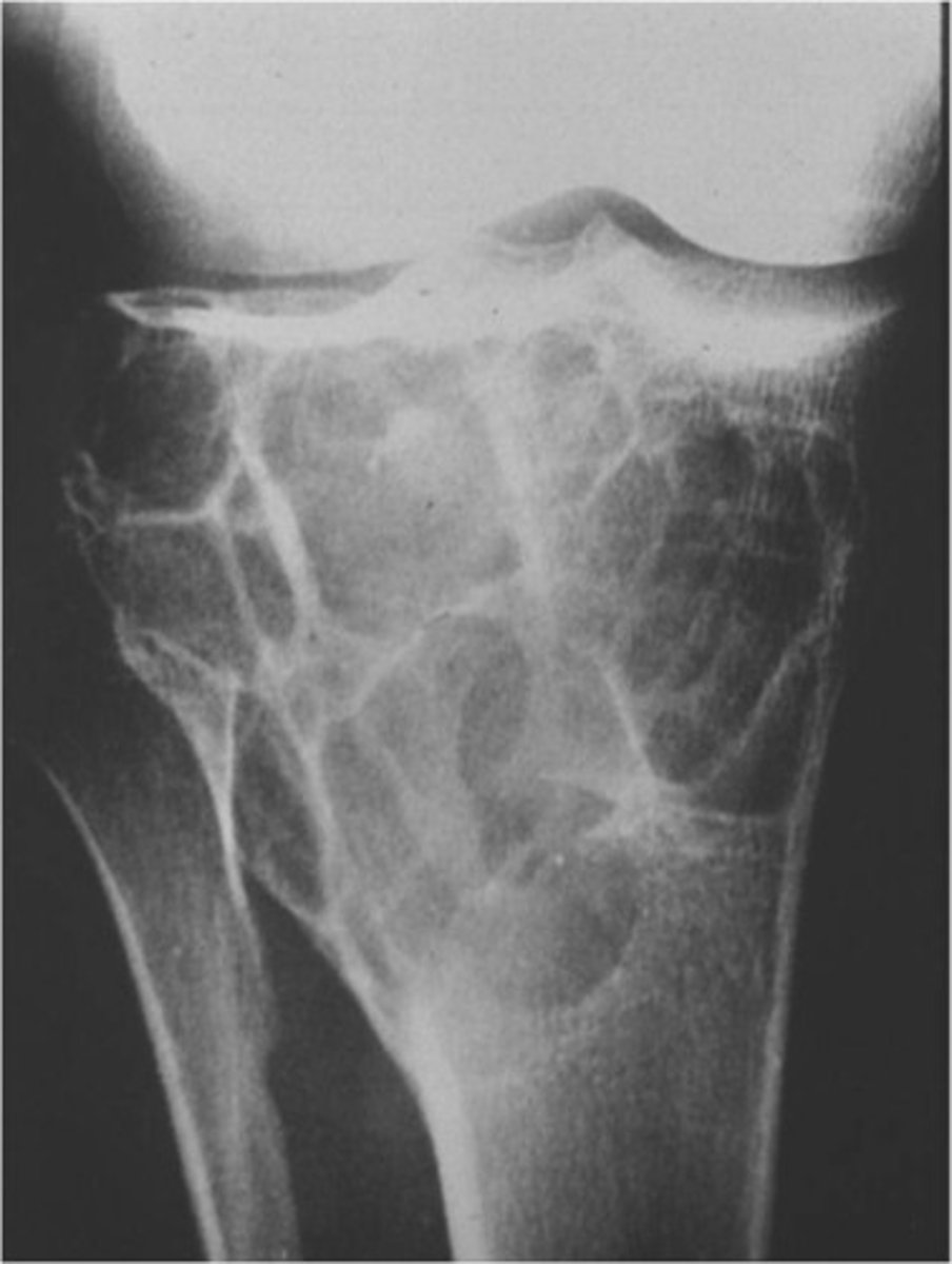 <p><strong>_____________ </strong>is a benign tumor that commonly occurs in the knee – often in the proximal tibia</p>