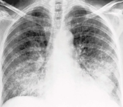 <p>Describe the RA of interstitial pneumonia</p>