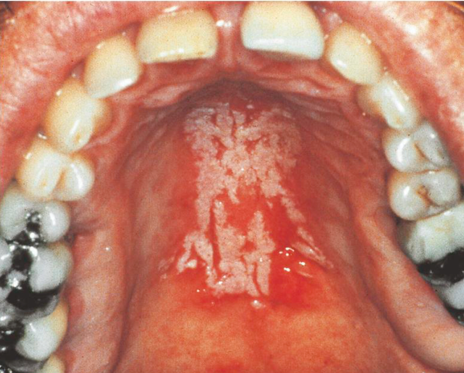 <p>Candidiasis (thrush) </p>