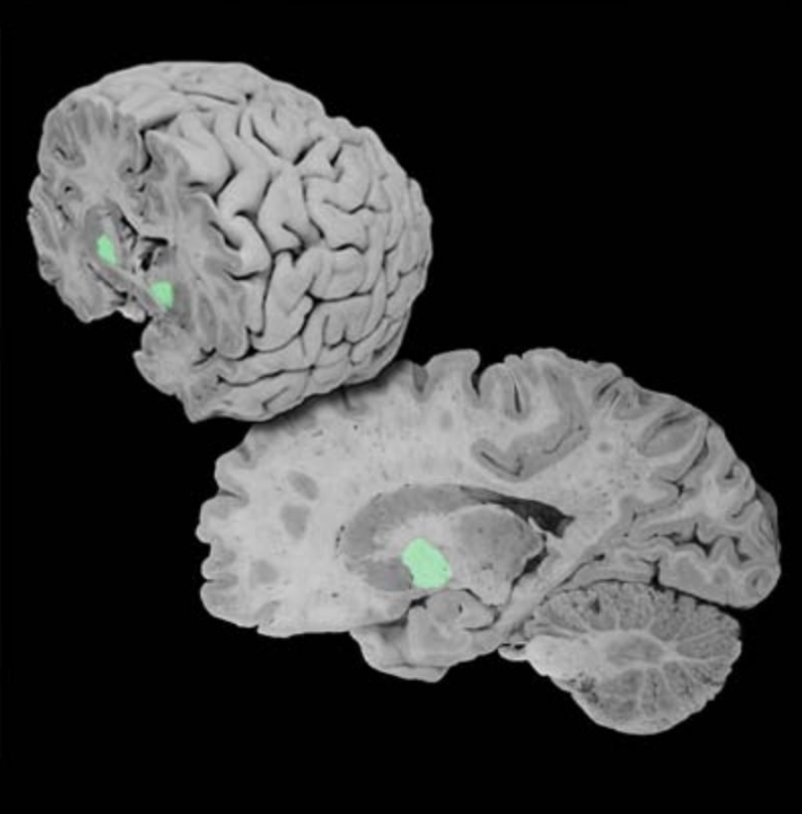 <p>Globus pallidus</p>