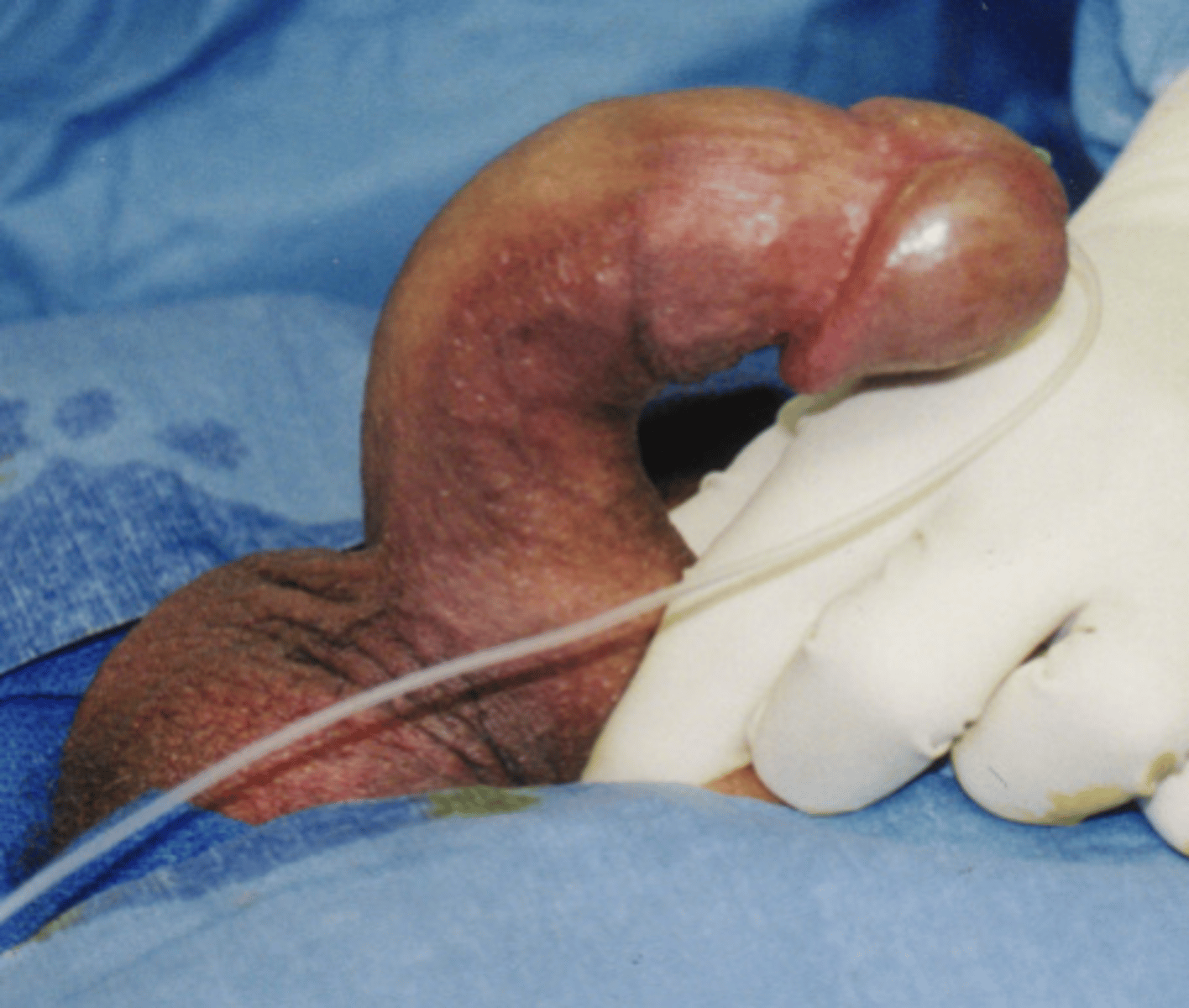 <p>Type of fibromatosis -&gt; fibrous growth </p><p>- Forms fibrous plaques on the penis </p><p>= Causes abnormal bending of the penis and painful erections </p>