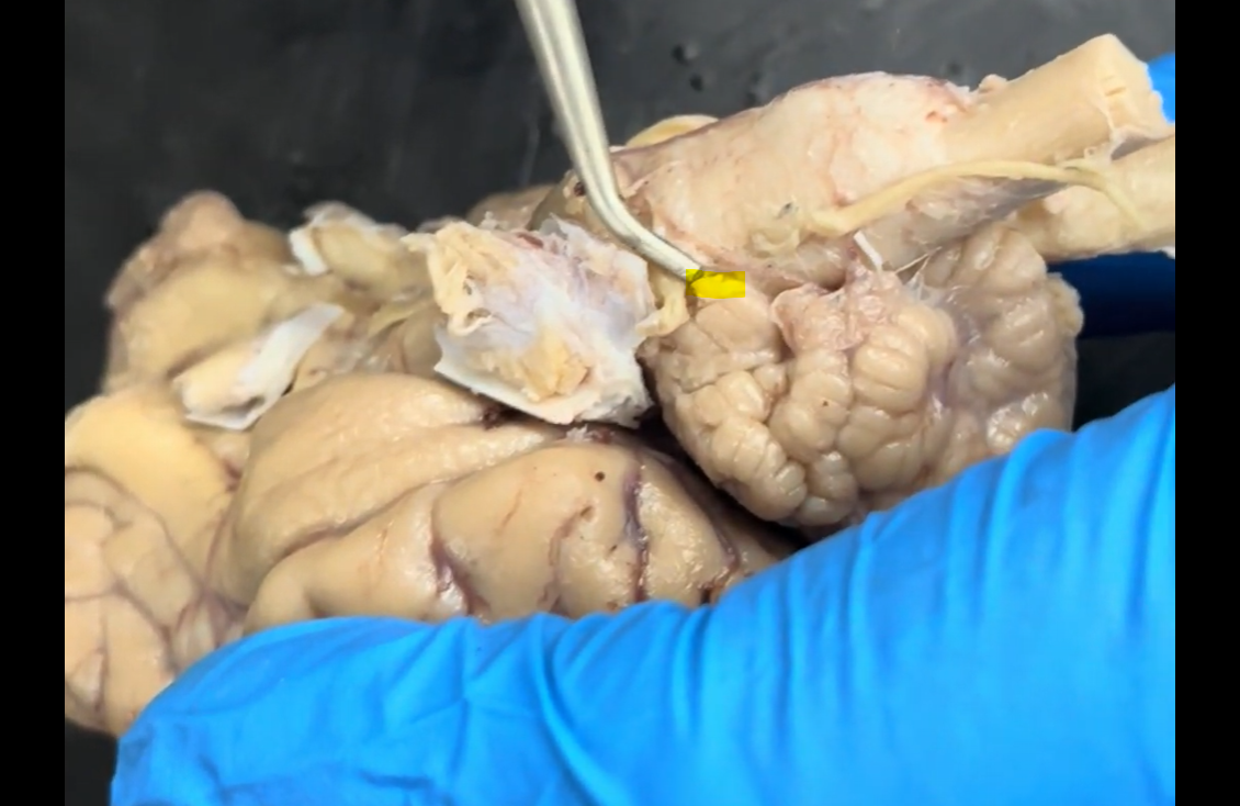 <p>Name the part of the brain at the tip of the probe and highlighted in yellow.</p>