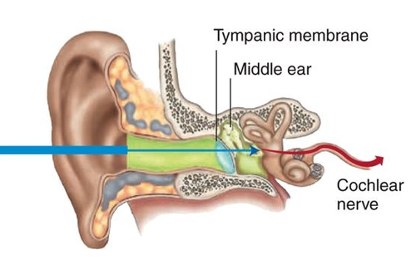 <p>Accumulation and hardening of earwax that blocks the ear canal, causing symptoms like earaches, temporary hearing loss, tinnitus, and a feeling of fullness.</p>