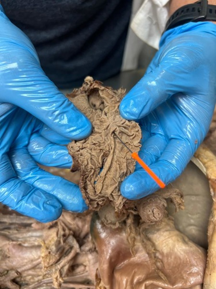 <p>major duodenal pappila</p>