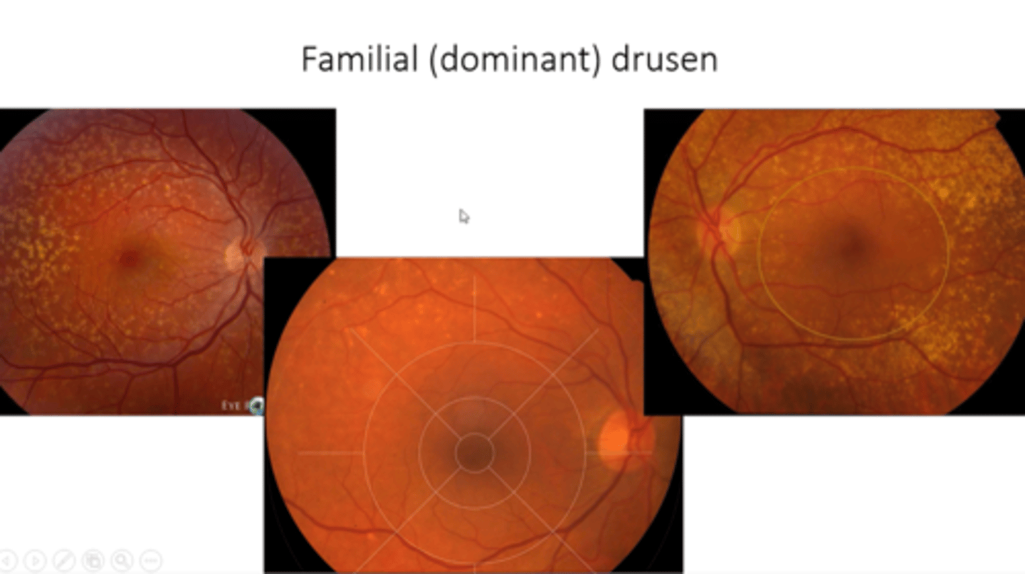 <p>midperipheral drusen outside macula = dominant, young as 20</p>