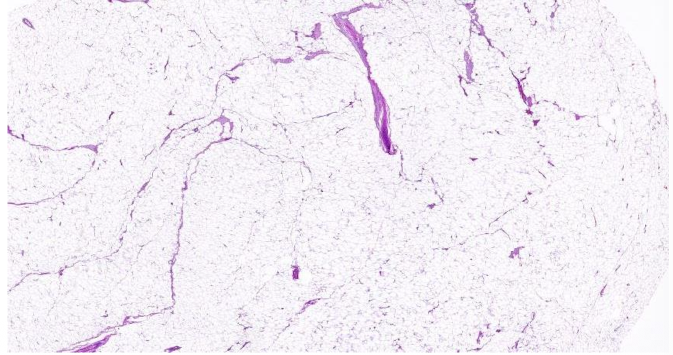 <p>welk type tumor</p>
