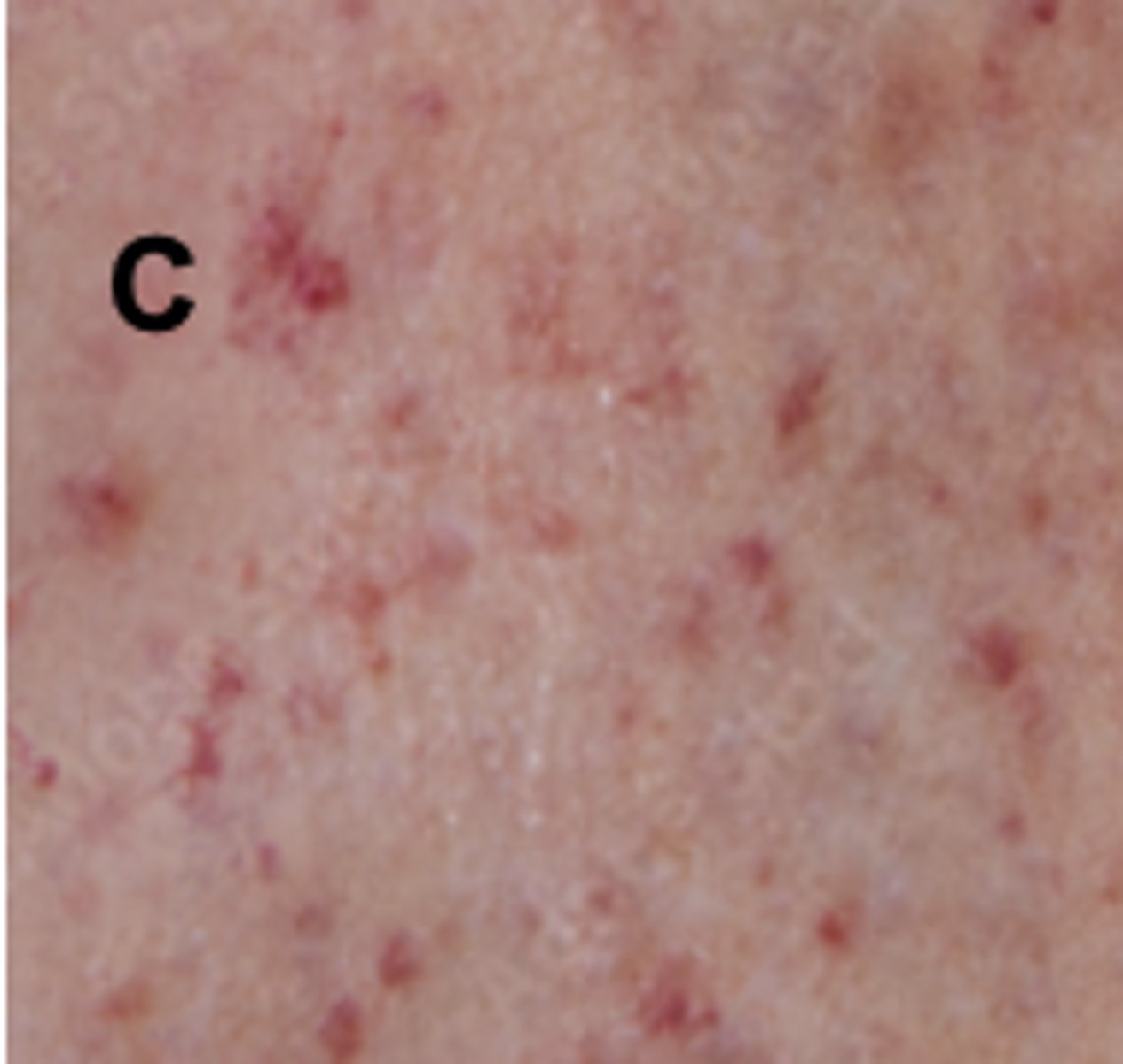 <p>petechiae</p>