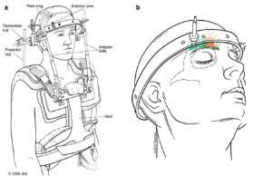 <p>Indications for halo brace? </p>