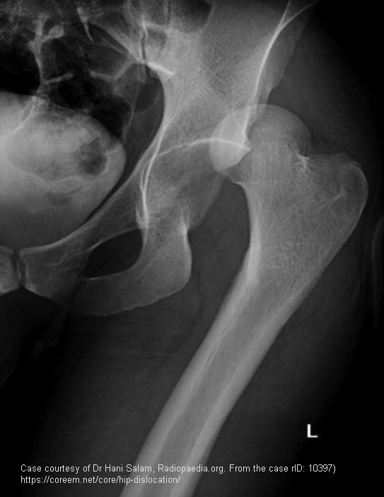 <p>Posterior dislocation.</p>