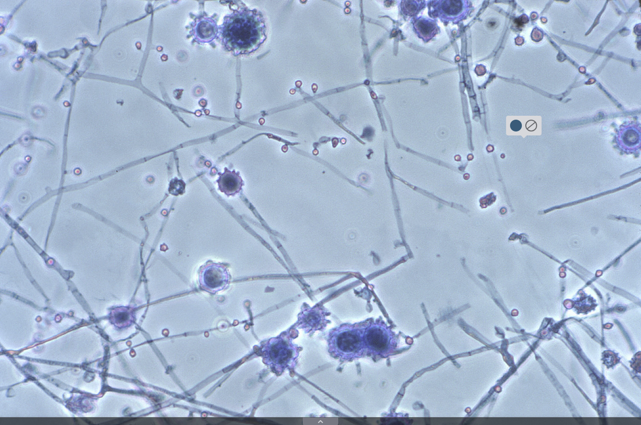 <p>2 weeks fever, dry cough, fatigue. went spelunking in central ameriaca recenmtly. cxr shows bilateral alveolar opacities &amp; hilar lymphadenopathy</p>