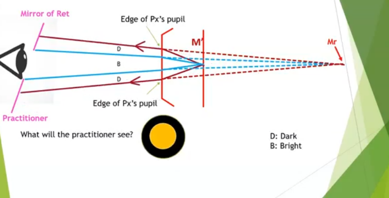 <p>lower hyperopia: far point further behind patients eye </p>