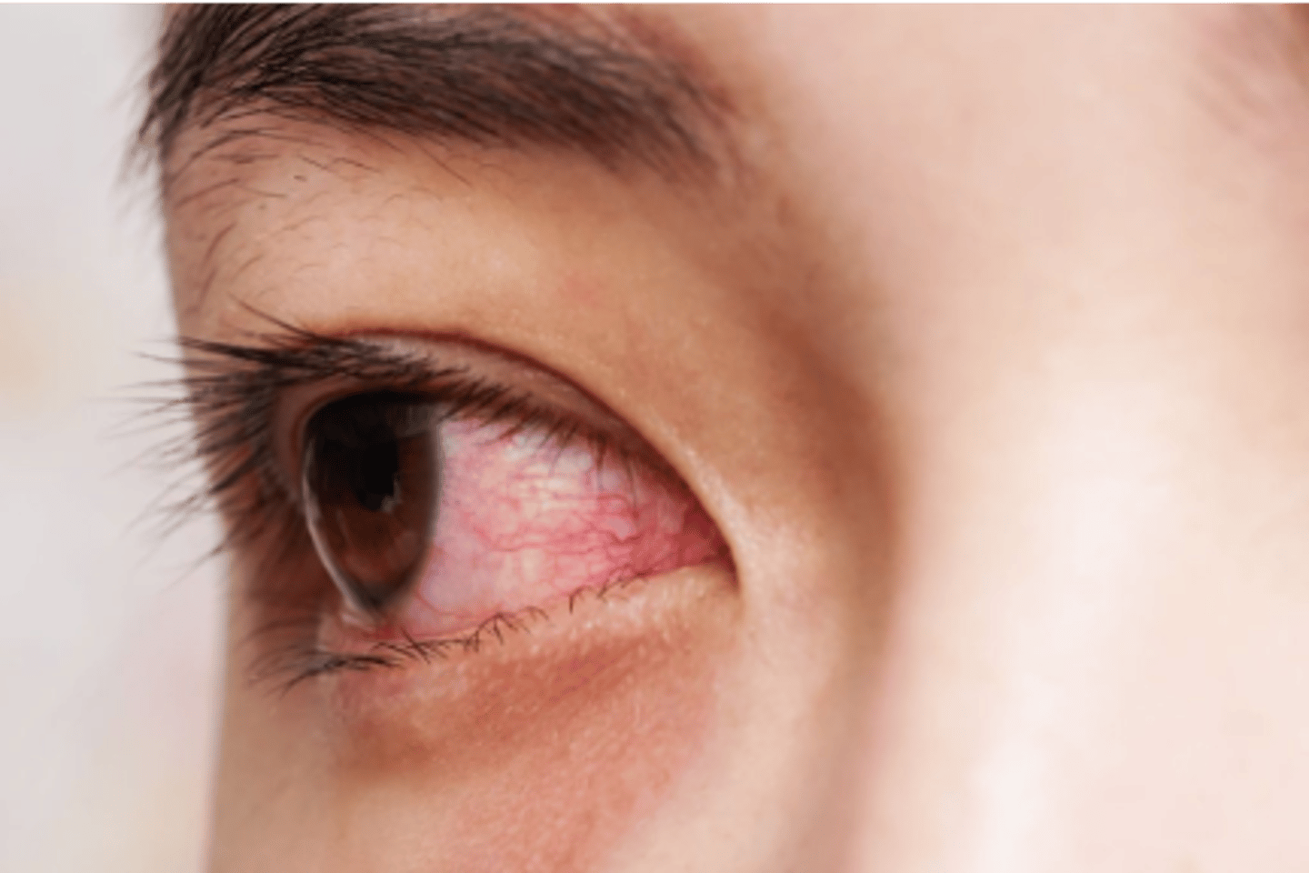<p>*inclusion conjunctivitis, that can turn to a prolonged unresponsive conjunctivis (doesn't respond to antibiotics) </p>