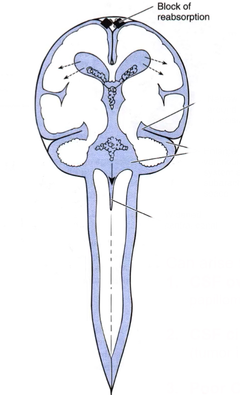 <p>can arise from 3 causes: CSF oversecretion (choroid papilloma), CSF circulation blockage (subarachnoid space tumor), poor CSF absorption (meningitis)</p><p>blockage of CSF flow <strong>outside</strong> of ventricular system</p><p>narrow space around midbrain in incisura</p><p>enlarged ventricular system and subarachnoid space</p><p>widened central canal</p>