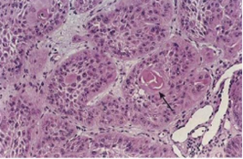 <p><strong><span>En las siguientes imágenes describa los hallazgos histológicos y grado de diferenciación</span></strong></p>